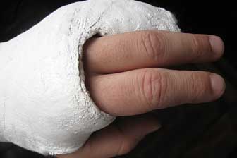 Gypsum plaster cast