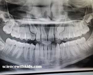 x-ray teeth